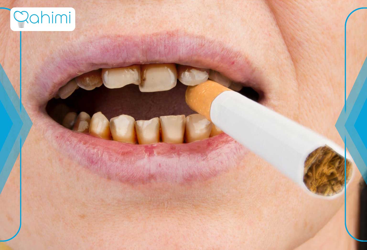 مصرف سیگار و دخانیات در سیاه شدن دندان