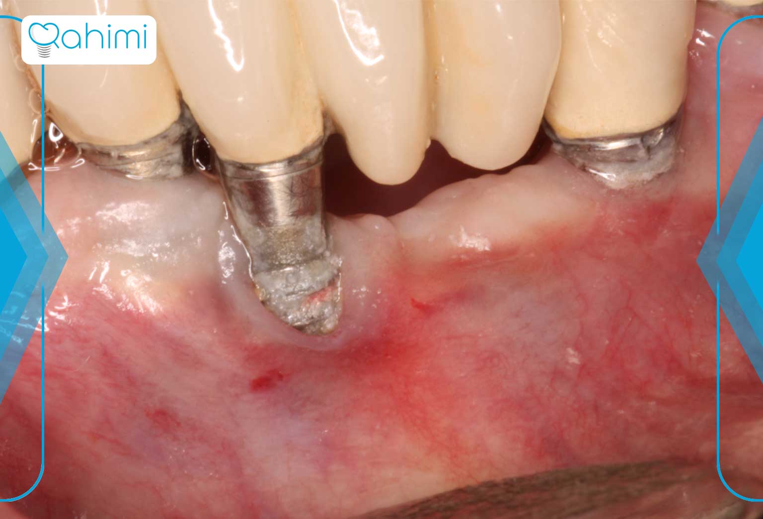 علائم عوارض ایمپلنت دندان 