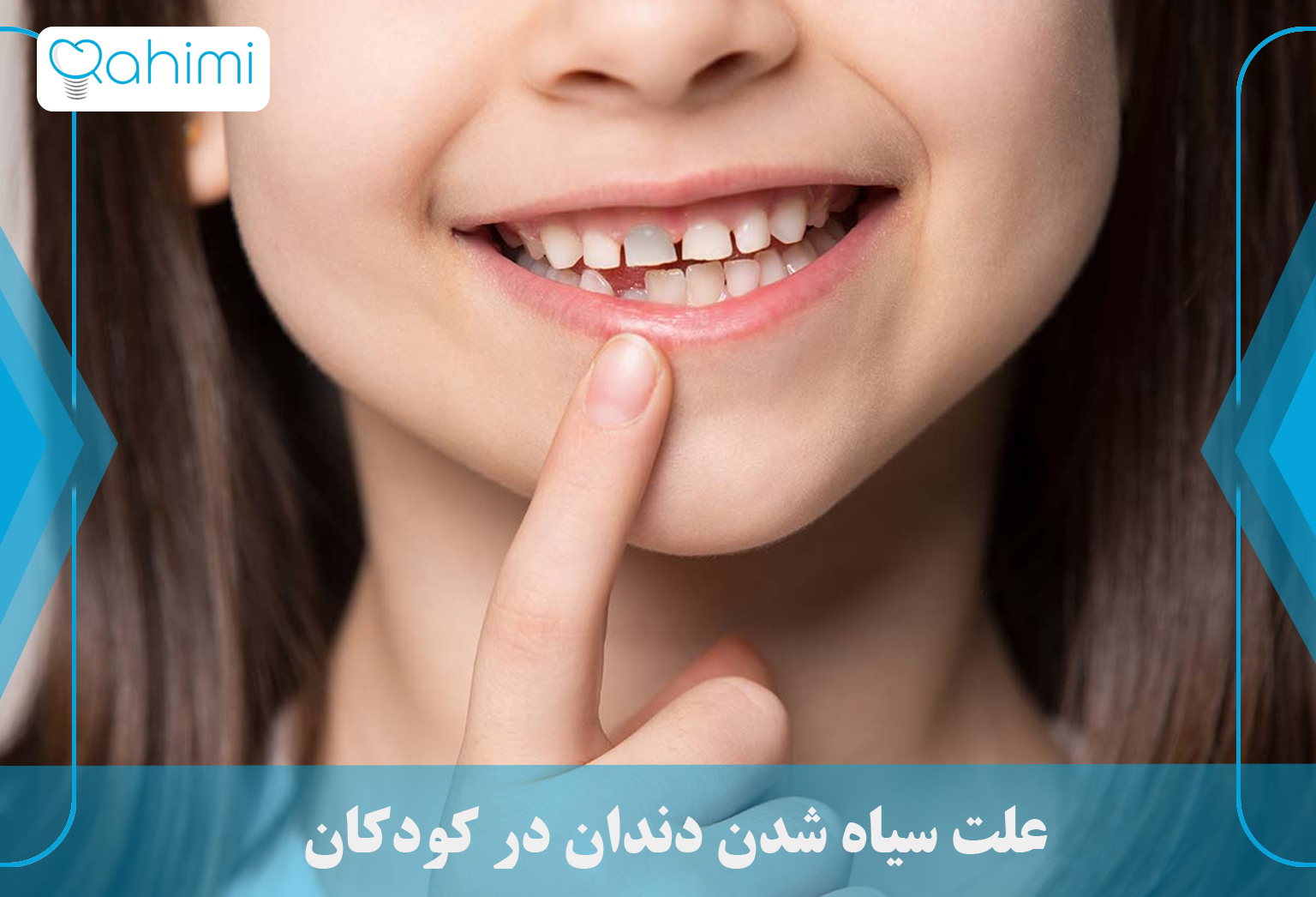 دلیل سیاه شدن دندان و بهترین روش های درمان سیاهی دندان 6 The cause of black teeth in children