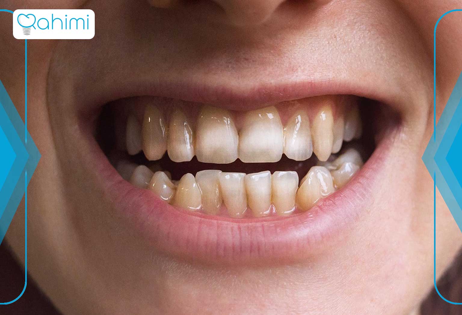 انواع سیاه شدن دندان