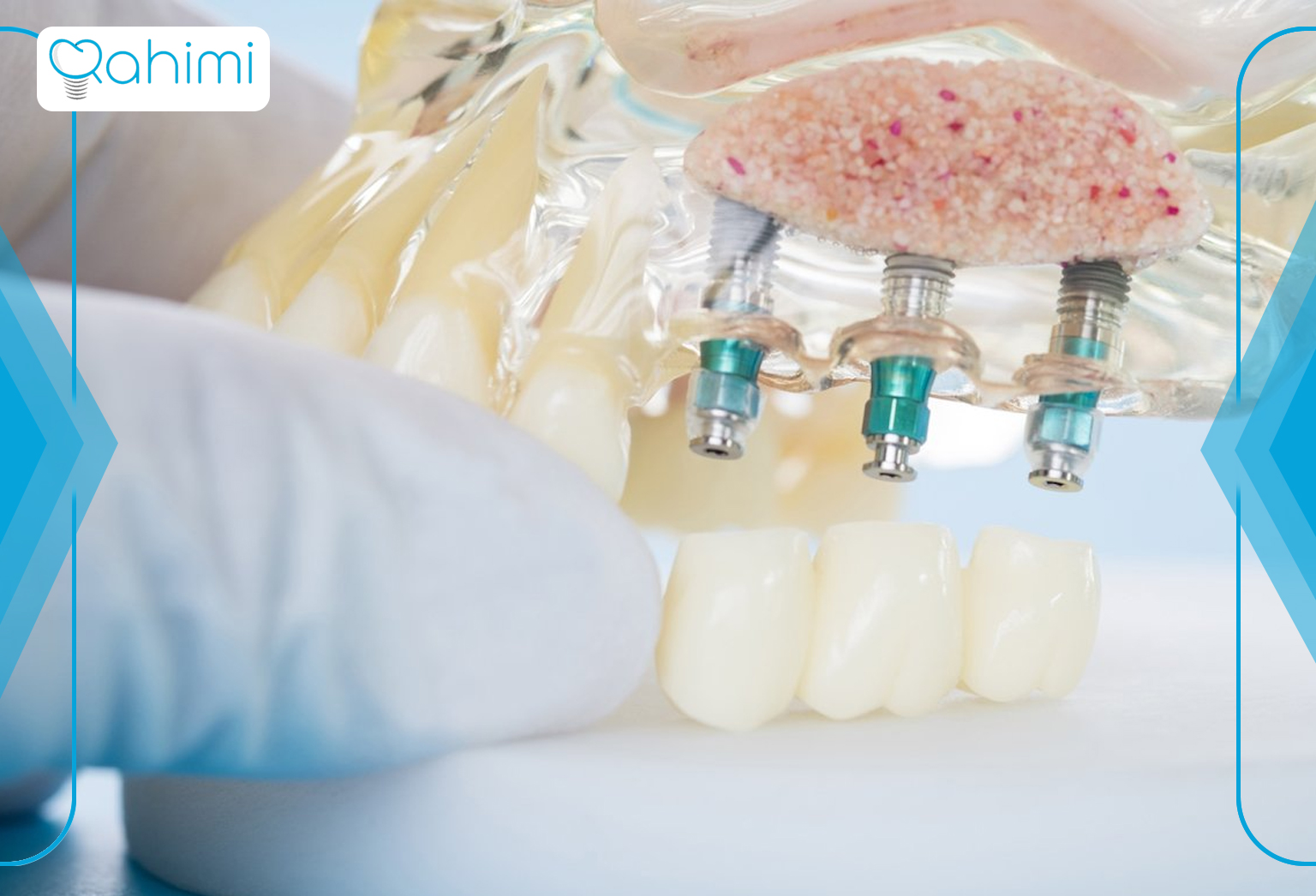 دکتر رحیمی: پیشگام در کاشت دندان در قم 5 Advantages of dental implants 1