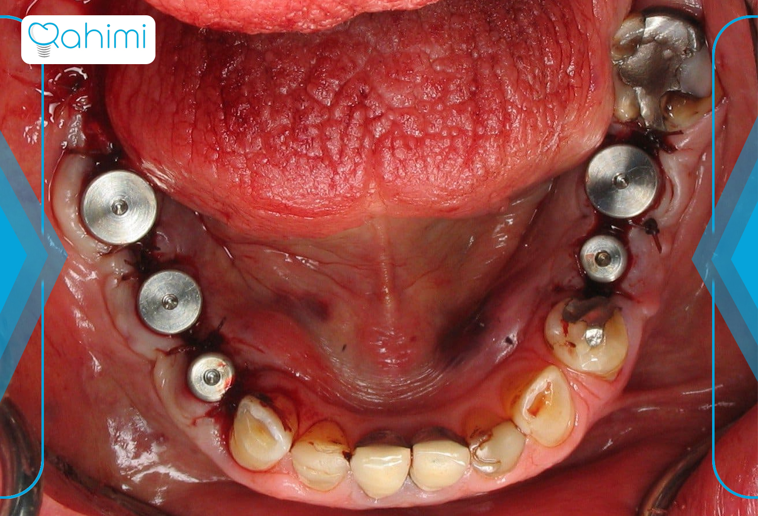دکتر رحیمی: پیشگام در کاشت دندان در قم 6 Dental implant immediately after extraction 1