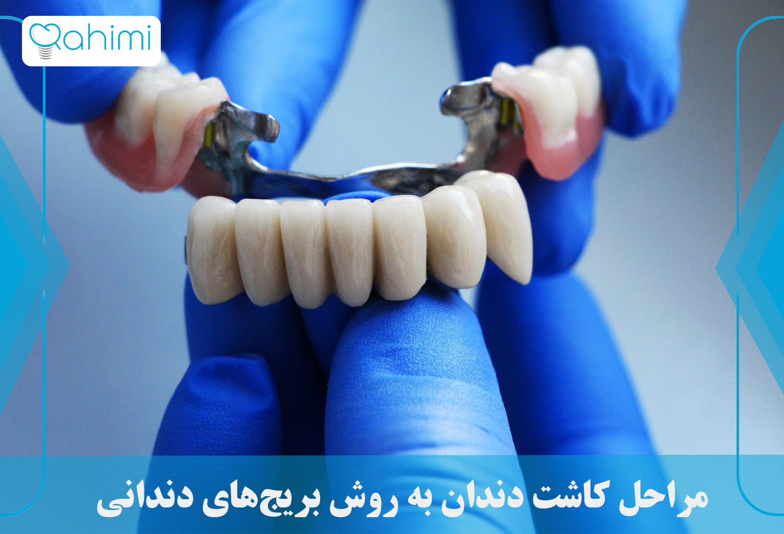 دکتر رحیمی: پیشگام در کاشت دندان در قم 3 Procedures of dental implants using dental bridges 1