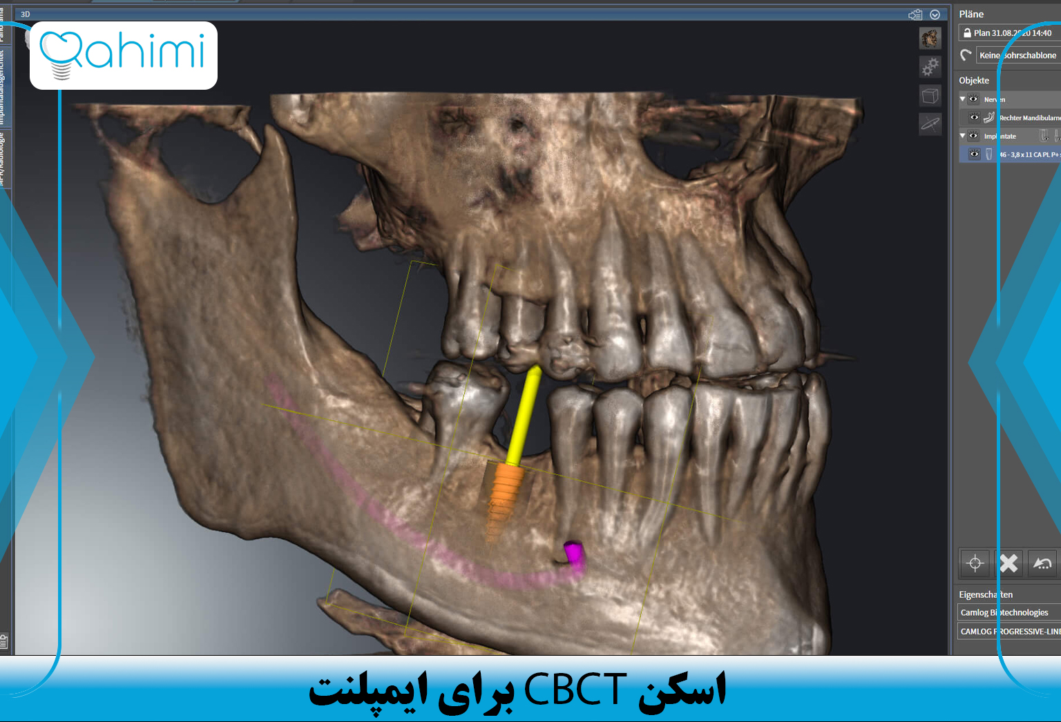 اسکن CBCT برای ایمپلنت 