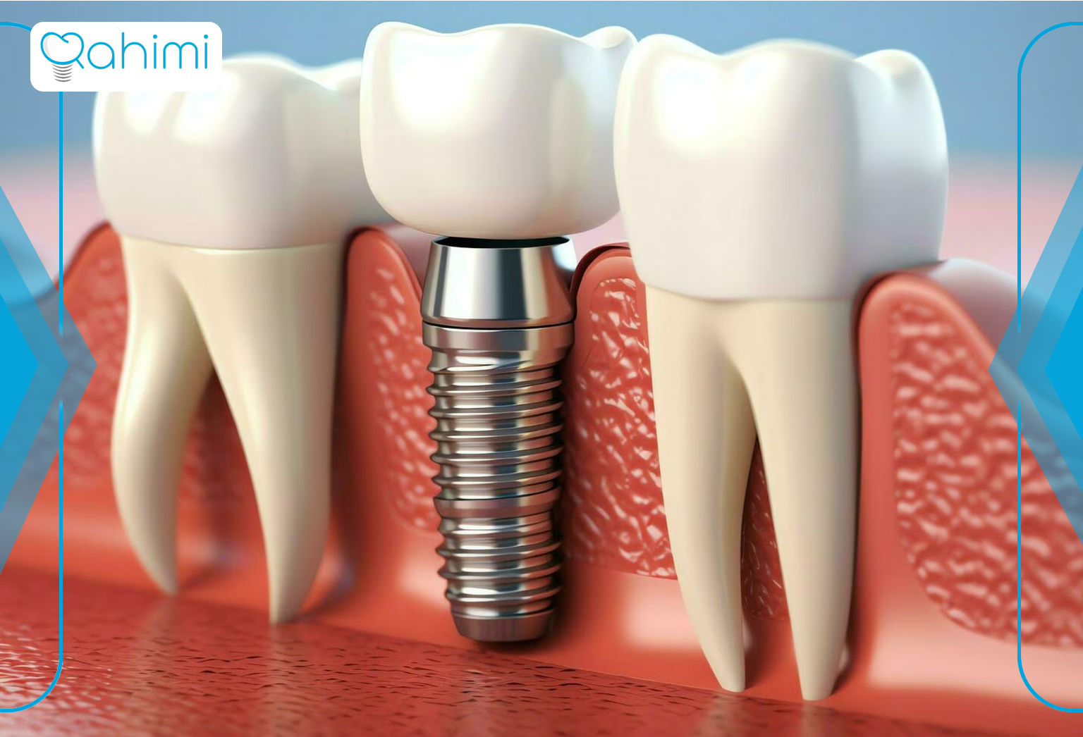 Maintaining the health of the teeth adjacent to the dental implant