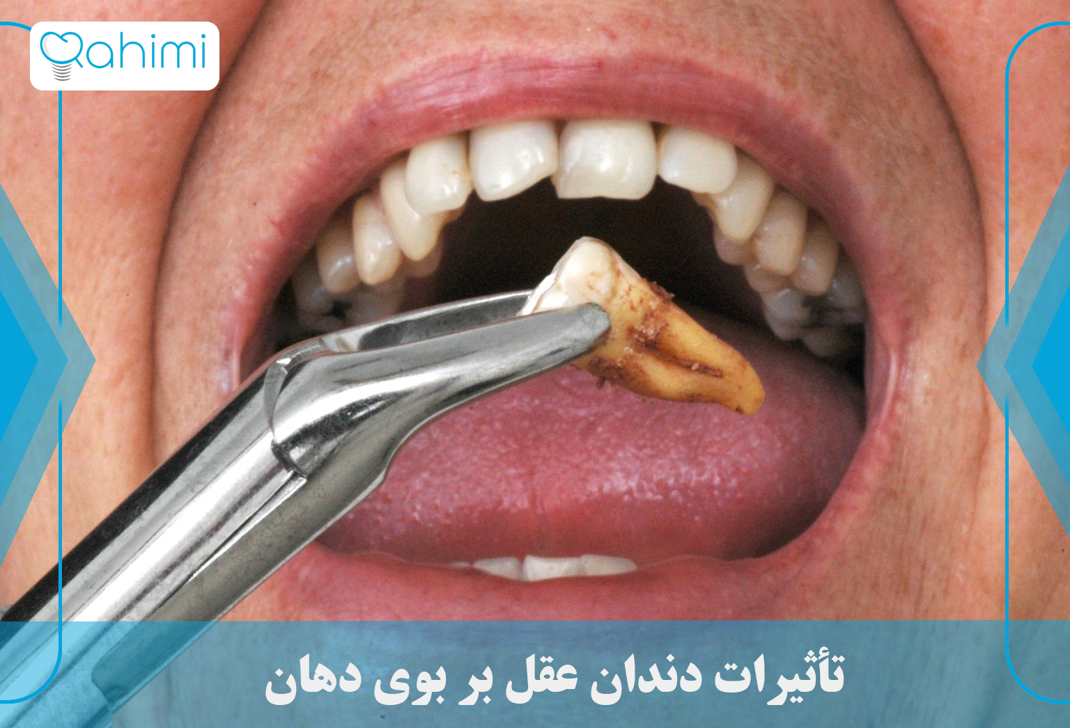 تأثیرات دندان عقل بر بوی دهان 