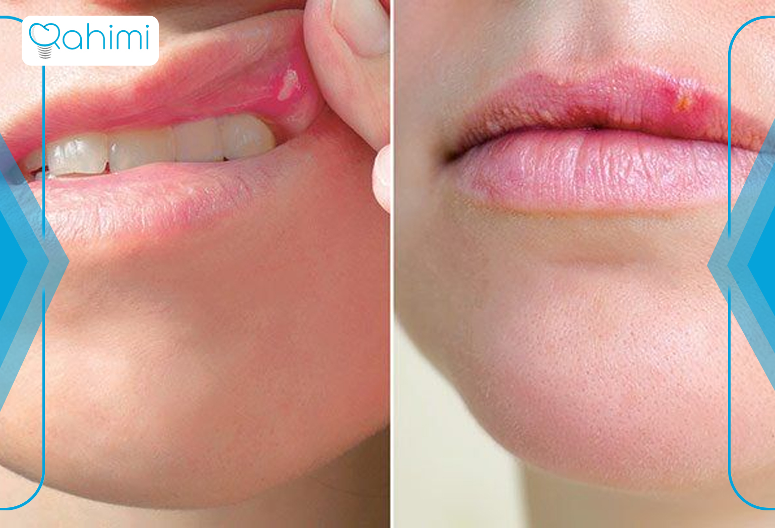 The difference between canker sores and cold sores