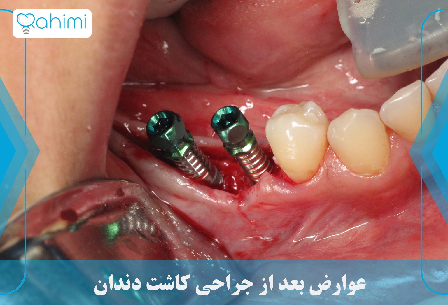 عوارض بعد از جراحی کاشت دندان