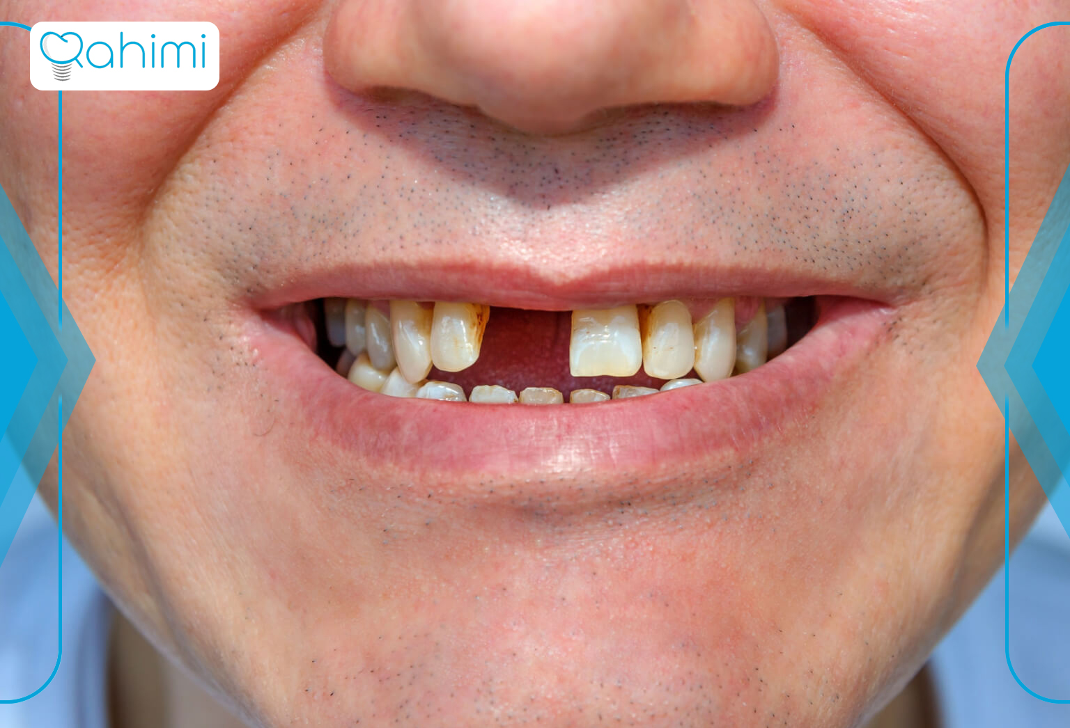 Tooth loss