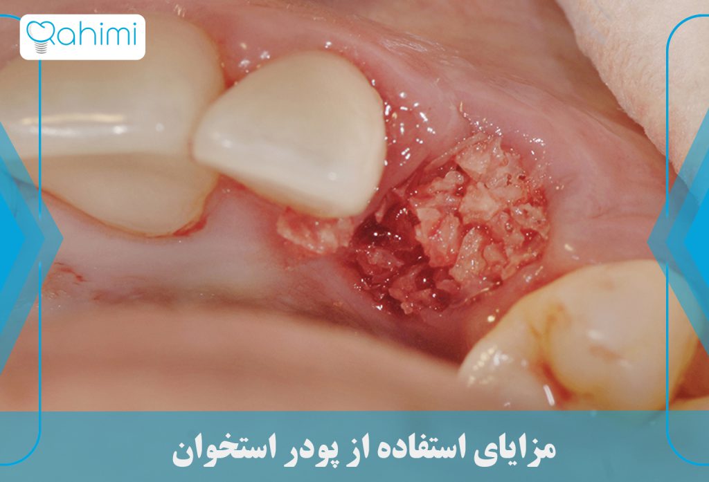نقش پودر استخوان در ایمپلنت دندان 7 مزایای استفاده از پودر استخوان