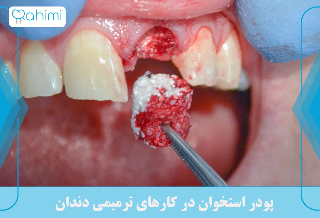 نقش پودر استخوان در ایمپلنت دندان 2 پودر استخوان در کارهای ترمیمی دندان