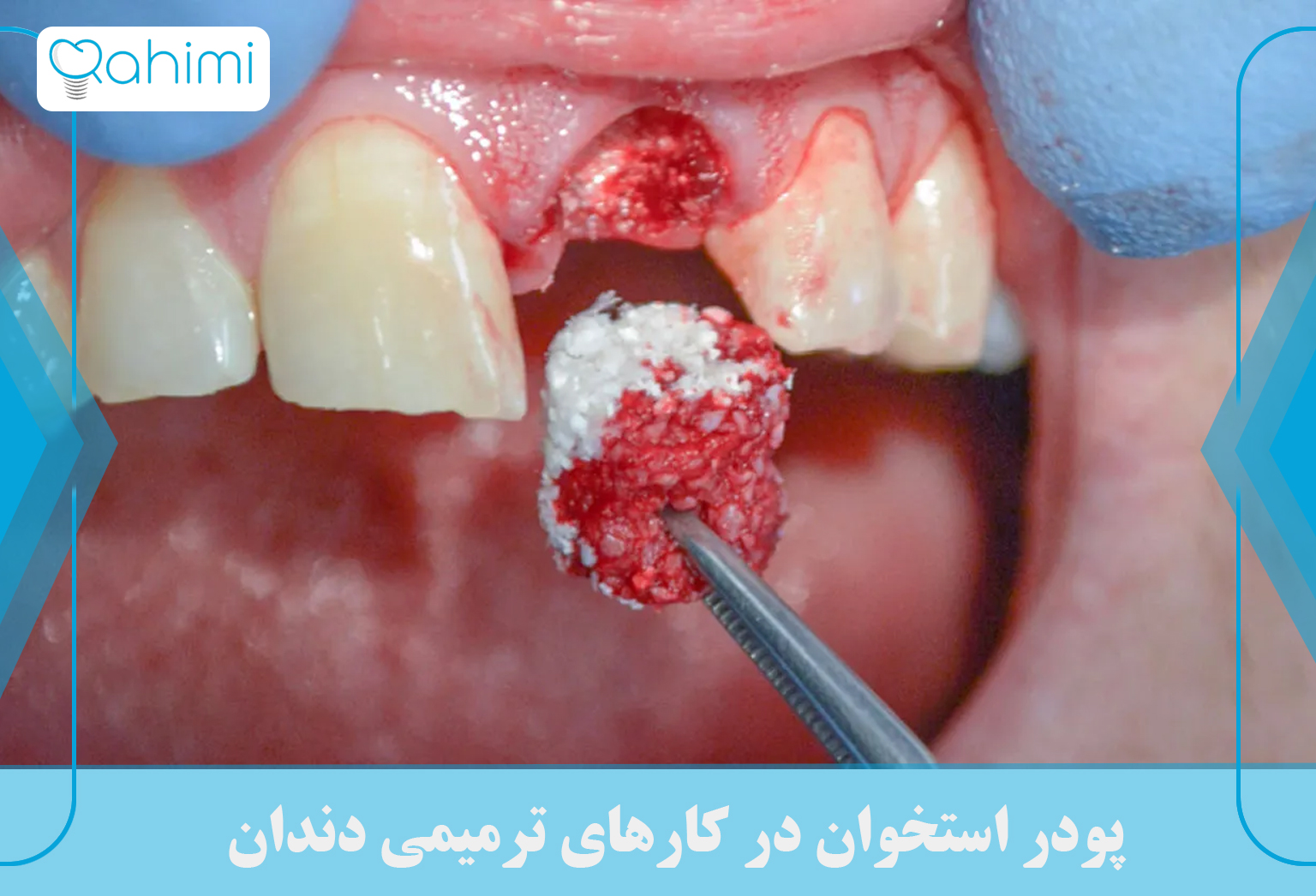 پودر استخوان در کارهای ترمیمی دندان