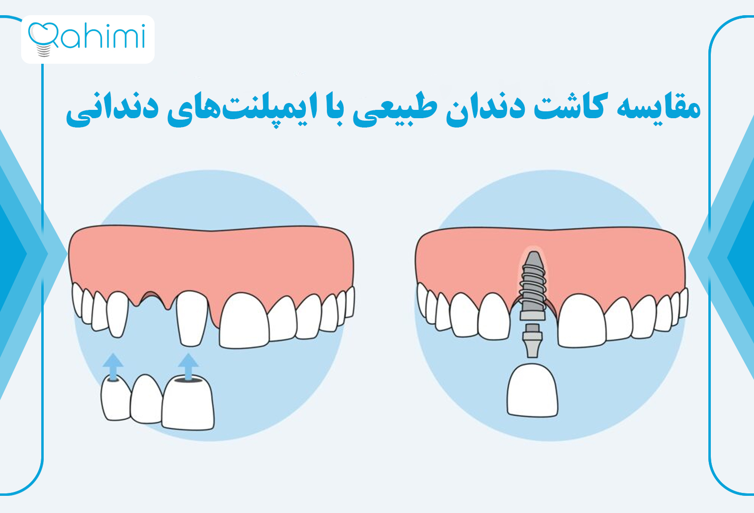 مقایسه کاشت دندان طبیعی با ایمپلنت‌های دندانی