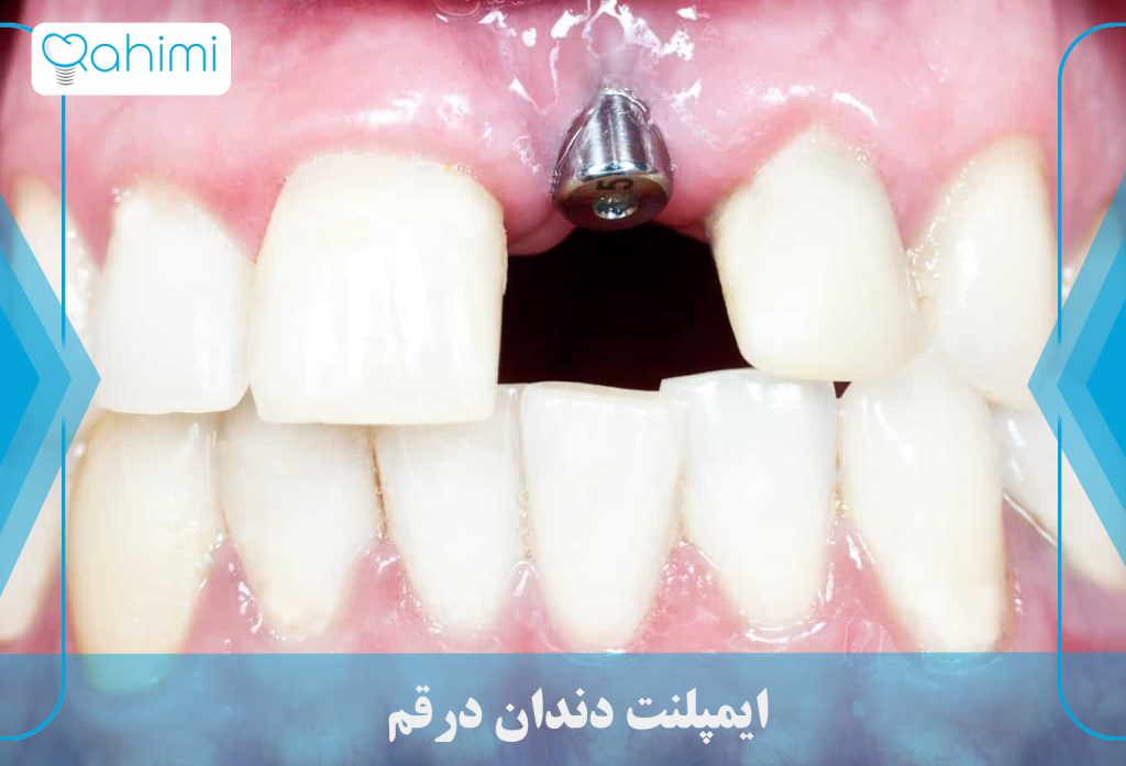 زمان انجام کاشت ایمپلنت دندان معمولی