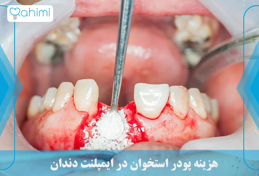 نقش پودر استخوان در ایمپلنت دندان 4 هزینه پودر استخوان در ایمپلنت دندان