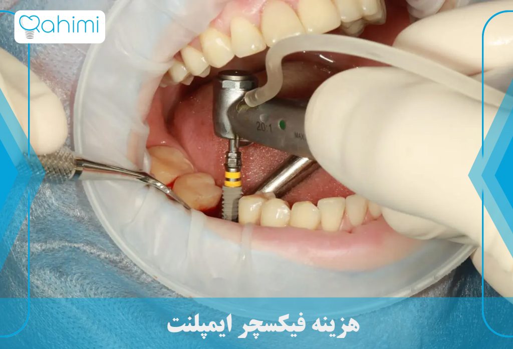 کاربرد فیکسچر بر پایه ایمپلنت چیست؟ 6 هزینه فیکسچر ایمپلنت