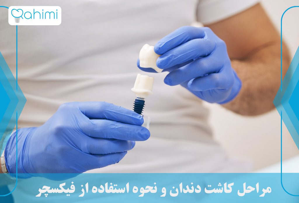 کاربرد فیکسچر بر پایه ایمپلنت چیست؟ 2 مراحل کاشت دندان و نحوه استفاده از فیکسچر