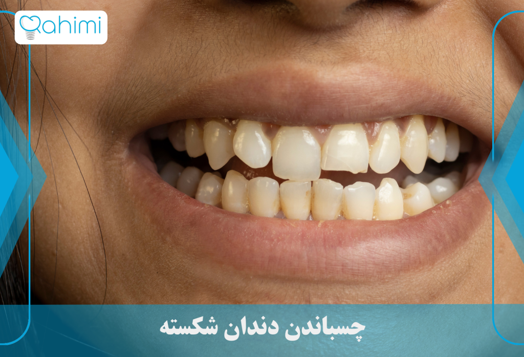 دندان شکسته