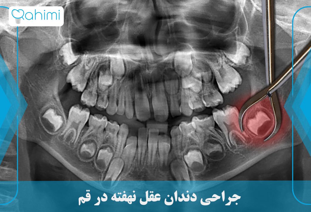 جراحی دندان در قم: درمانهای تخصصی با کیفیت و حرفهای (دکتر رحیمی) 2 جراحی دندان عقل نهفته در قم