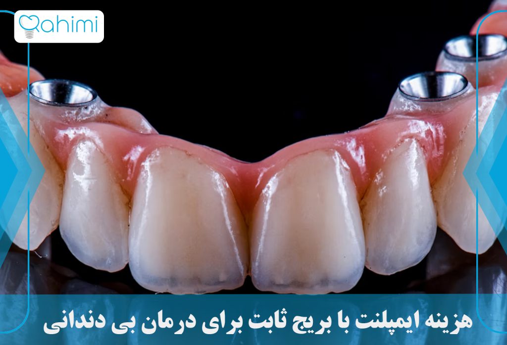 مقایسه هزینه ایمپلنت با بریج ثابت برای درمات بی دندانی