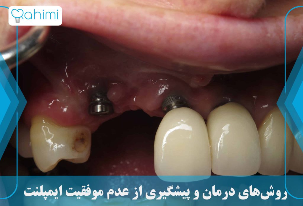 بررسی علائم و دلایل عدم موفقیت ایمپلنت دندان 2 روشهای درمان و پیشگیری از عدم موفقیت ایمپلنت
