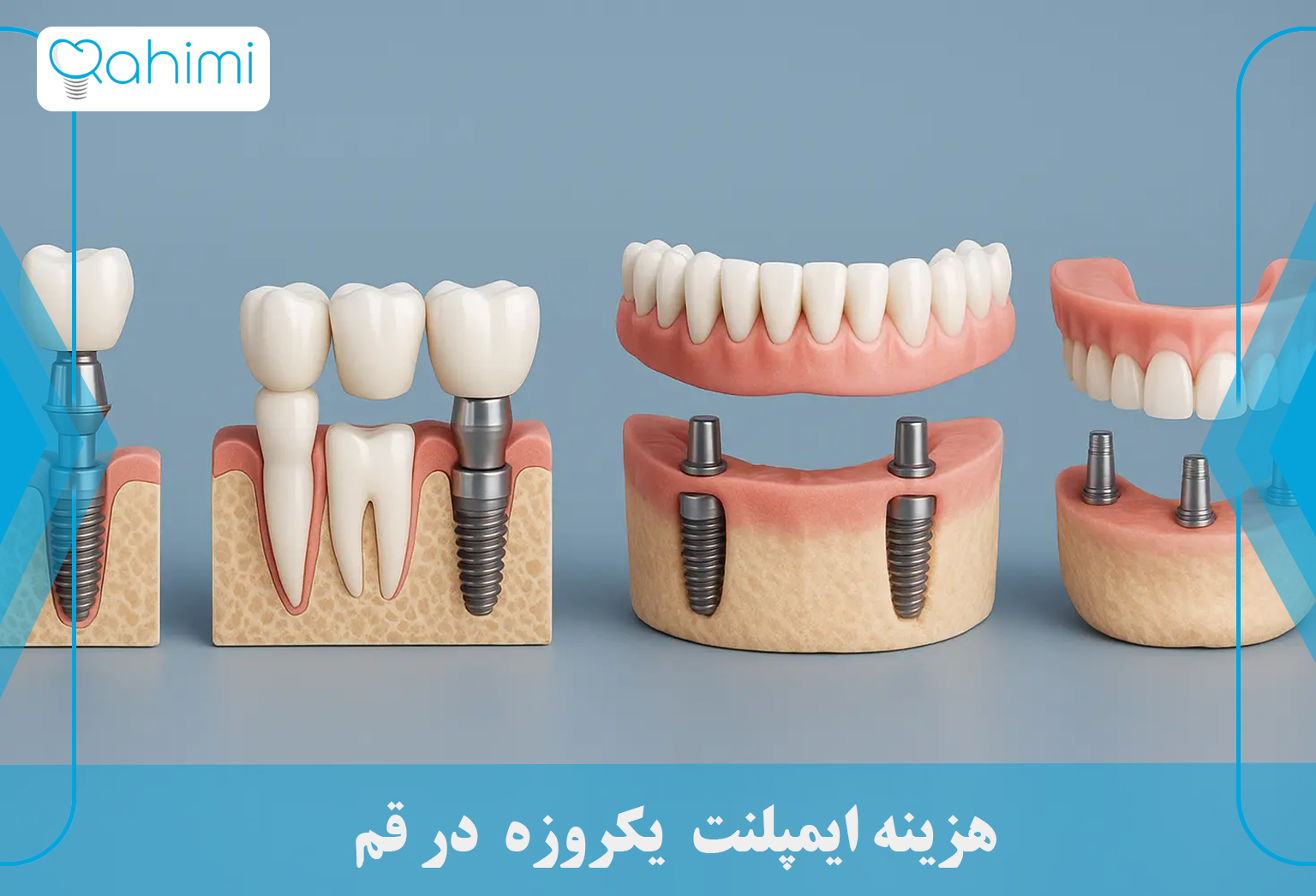 هزینه ایمپلنت یکروزه در قم