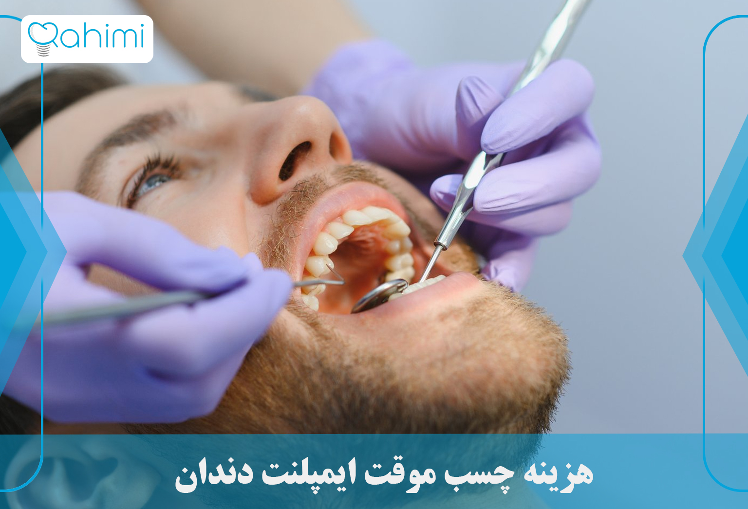 هزینه چسب موقت ایمپلنت دندان
