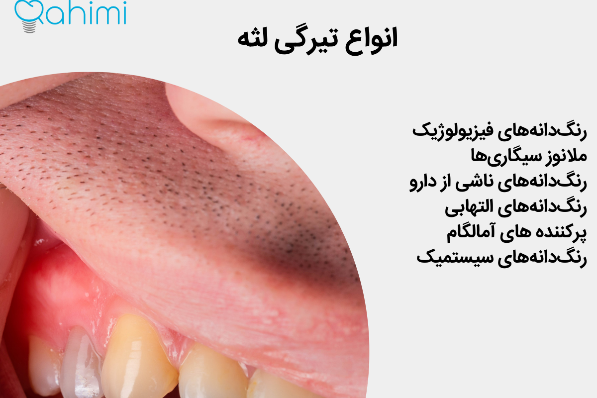 انواع تیرگی لثه