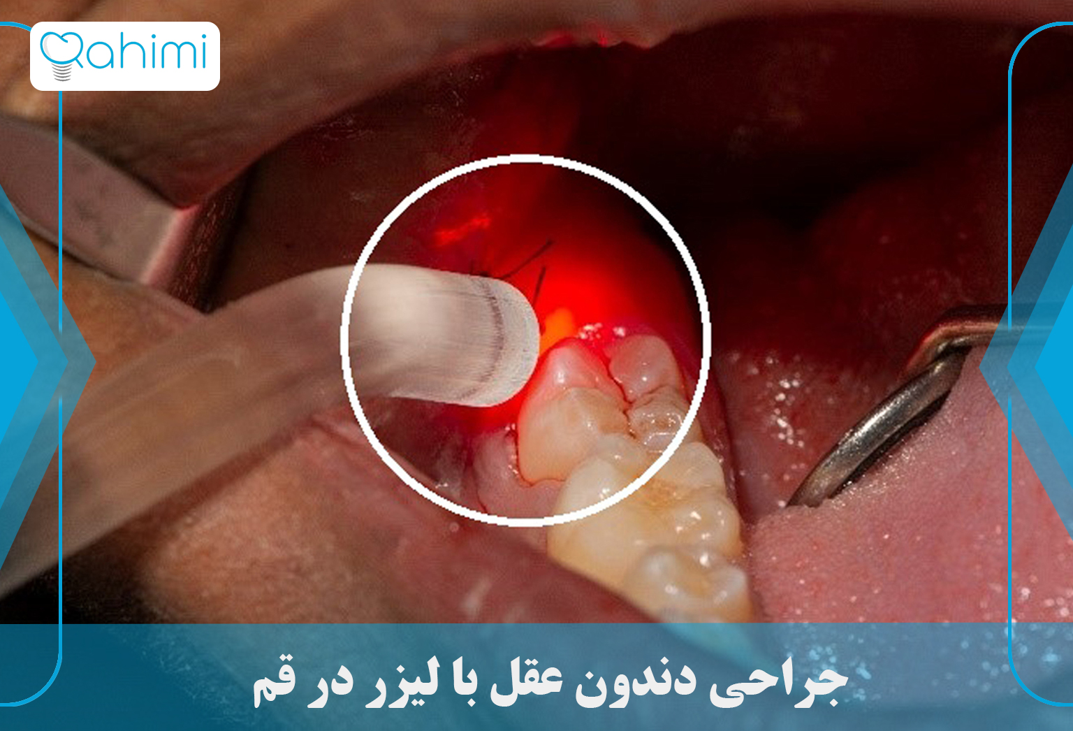 جراحی دندون عقل با لیزر در قم