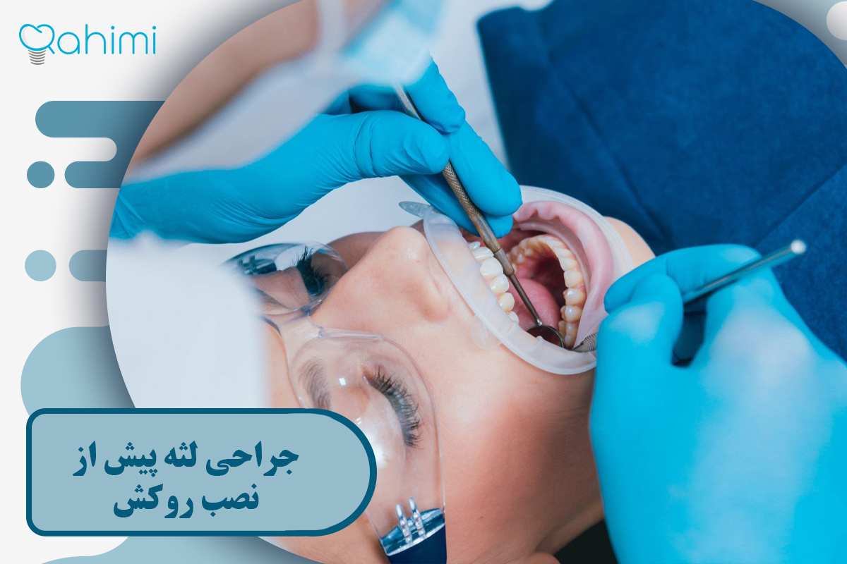 جراحی لثه پیش از نصب روکش