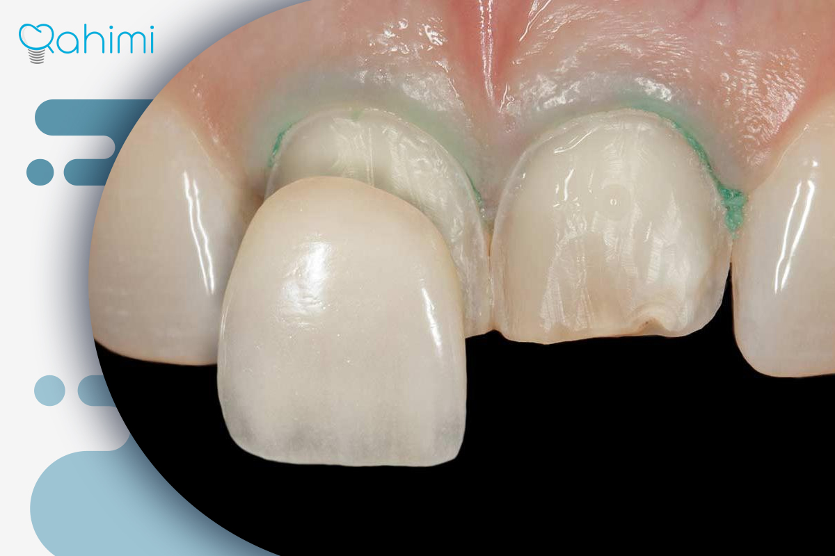نصب روکش بدون جراحی
