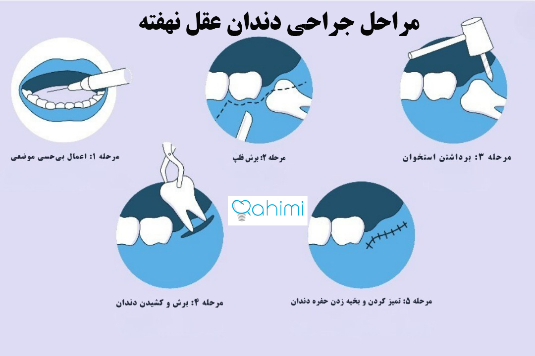 مراحل جراحی دندان عقل نهفته
