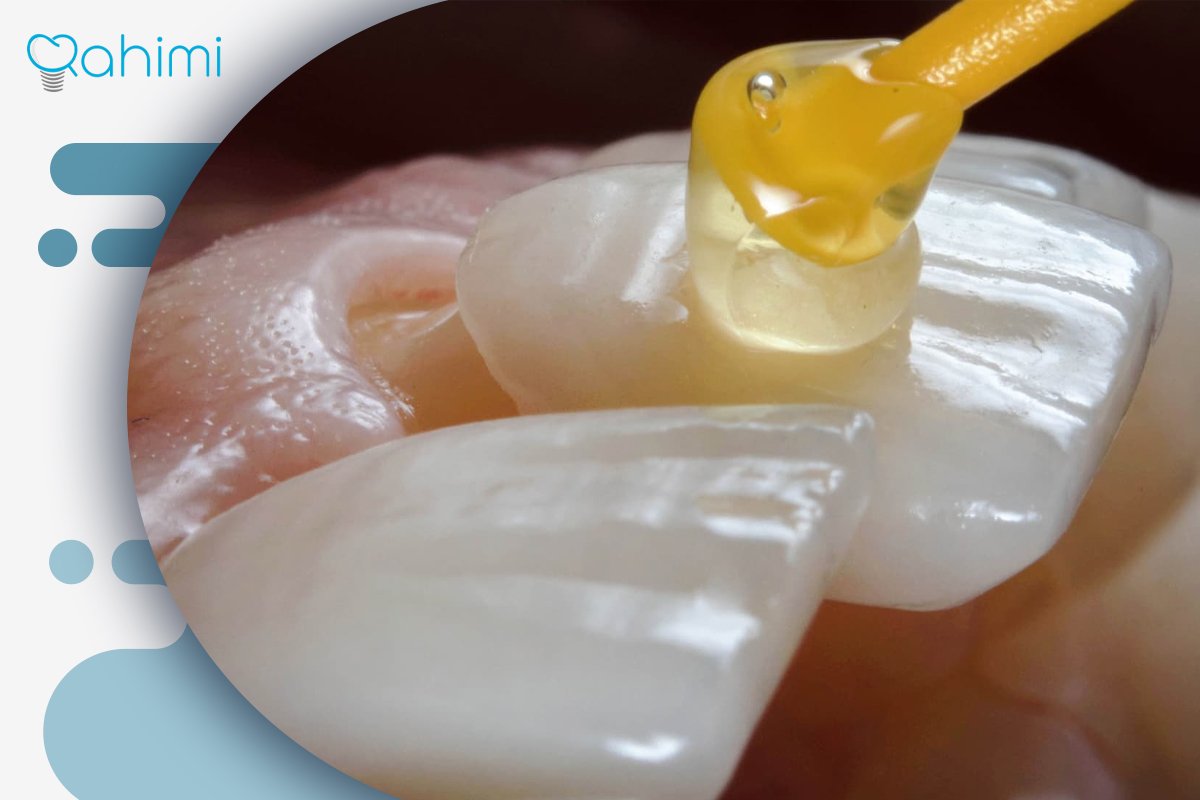لمینت سرامیکی و کامپوزیتی
