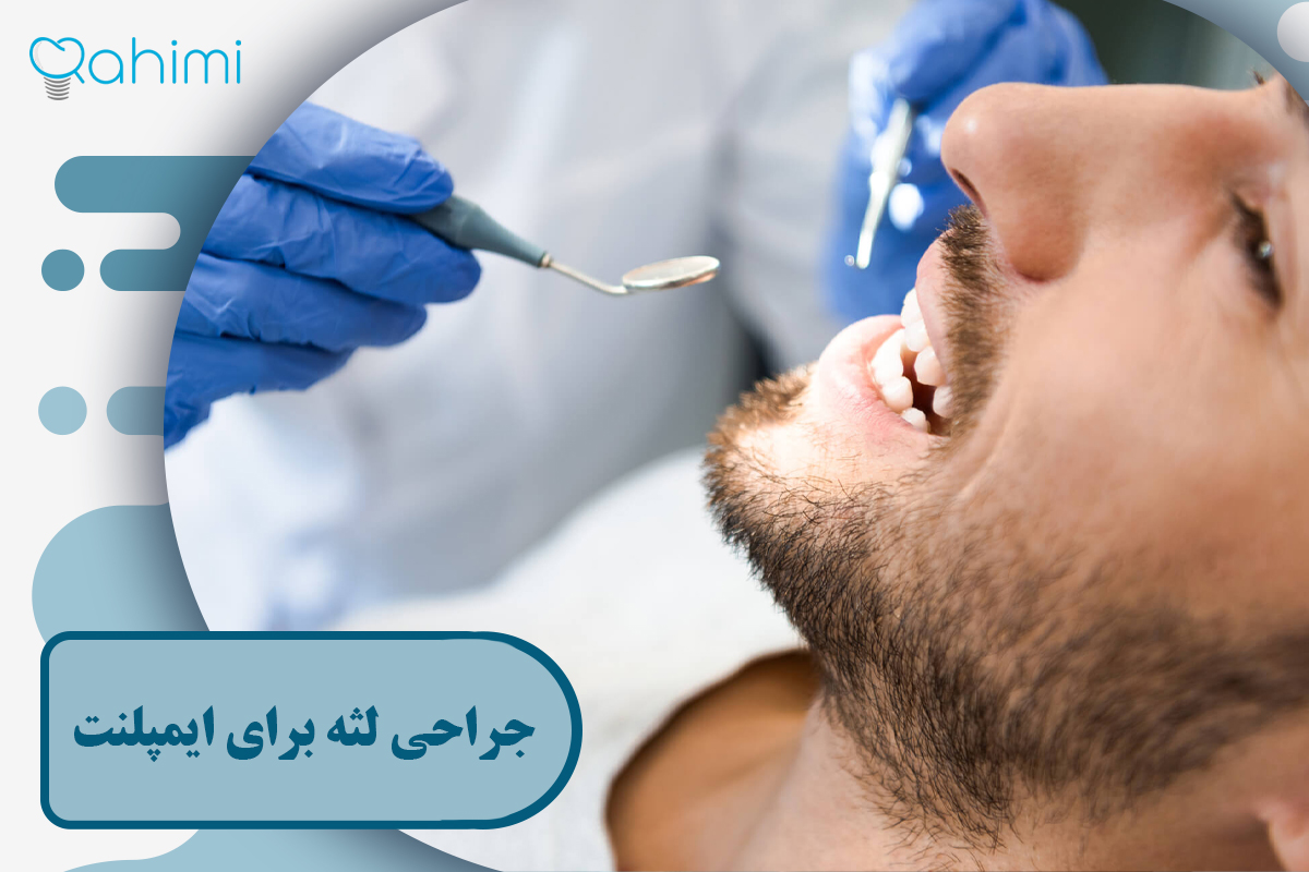 جراحی لثه برای ایمپلنت