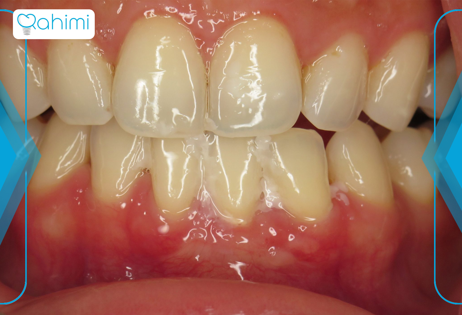 Atrophied gums without surgery