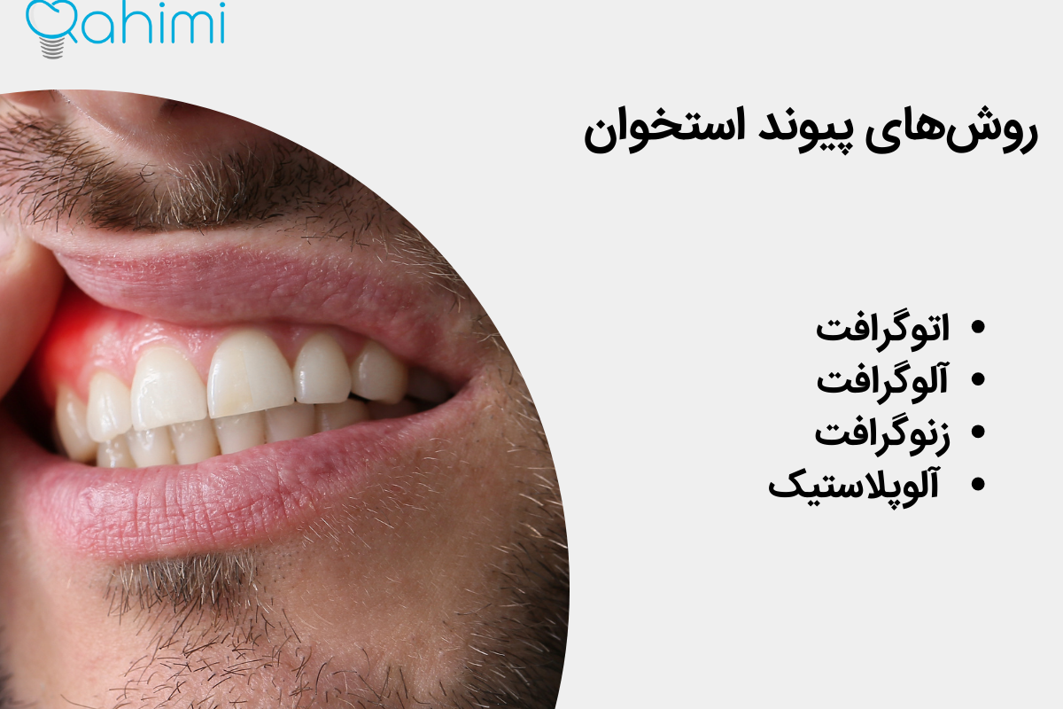 روش‌های پیوند استخوان