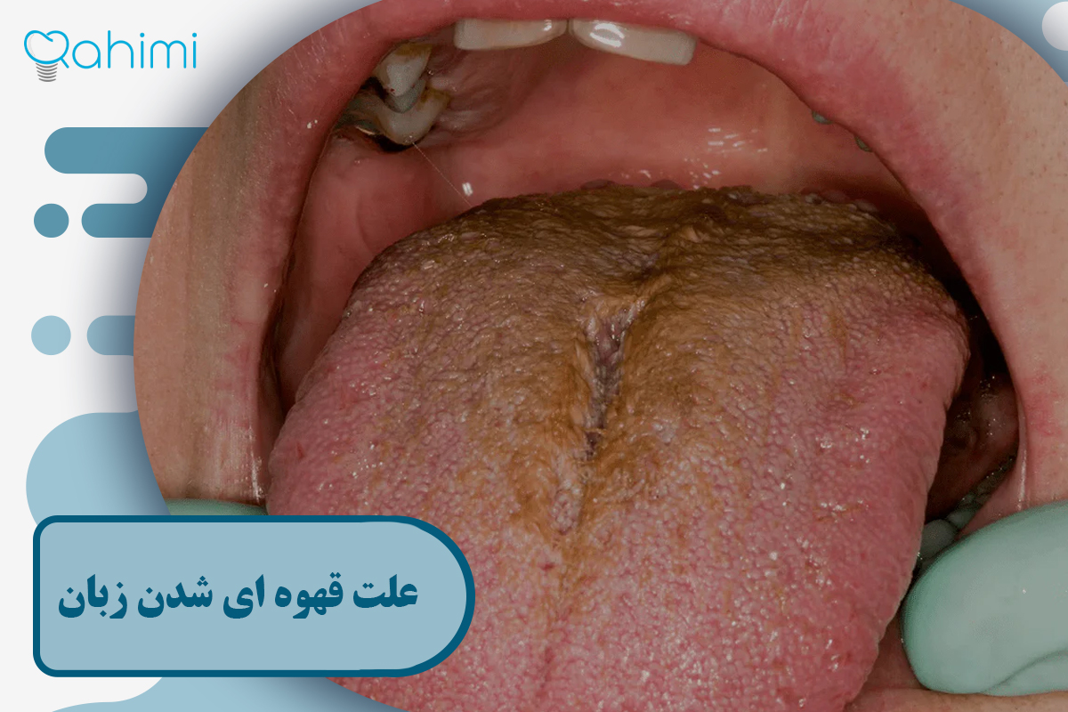 قهوه ای شدن زبان