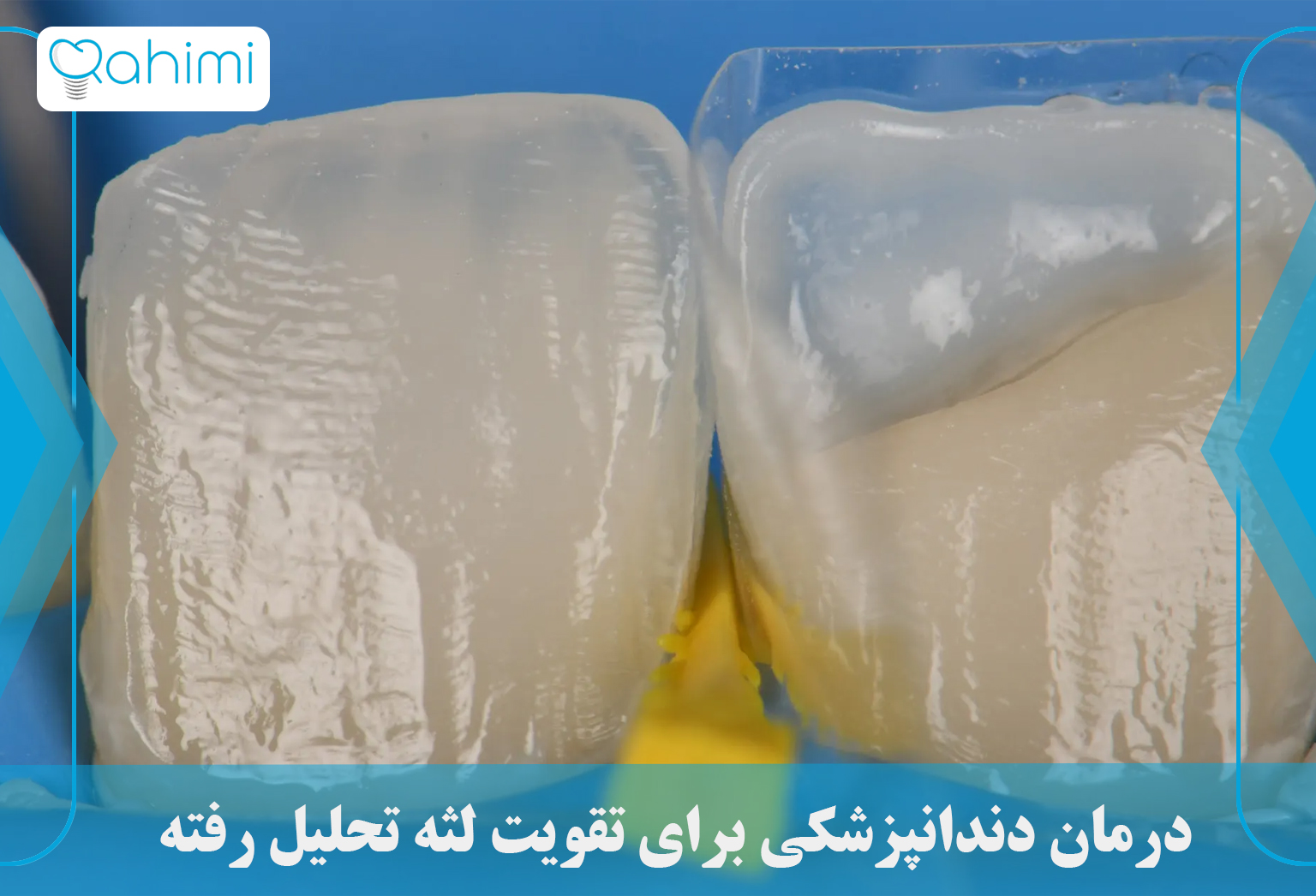 Dental treatment to strengthen decayed gums 1