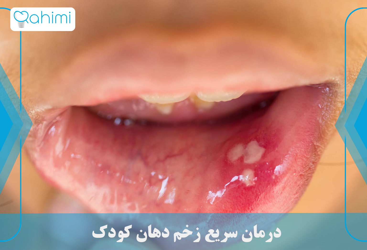 درمان آفت دهان و زخم زبان و لب 12 Quick treatment for mouth ulcers in children