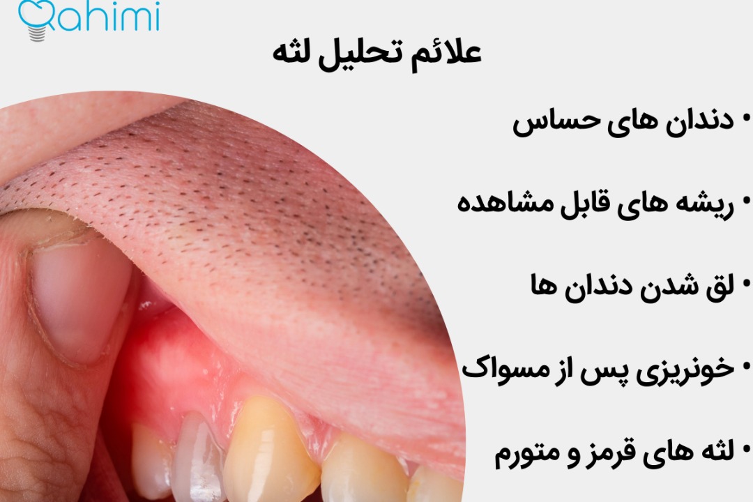 Symptoms of gingivitis