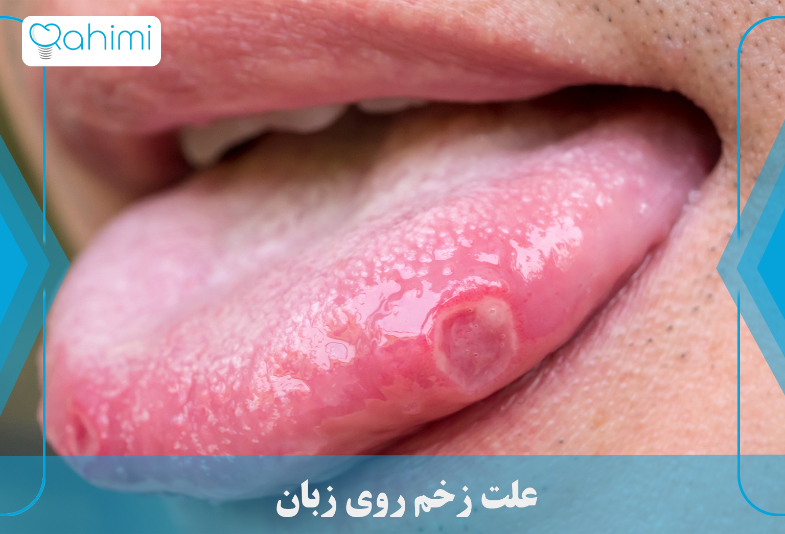 درمان آفت دهان و زخم زبان و لب 4 The cause of sores on the tongue