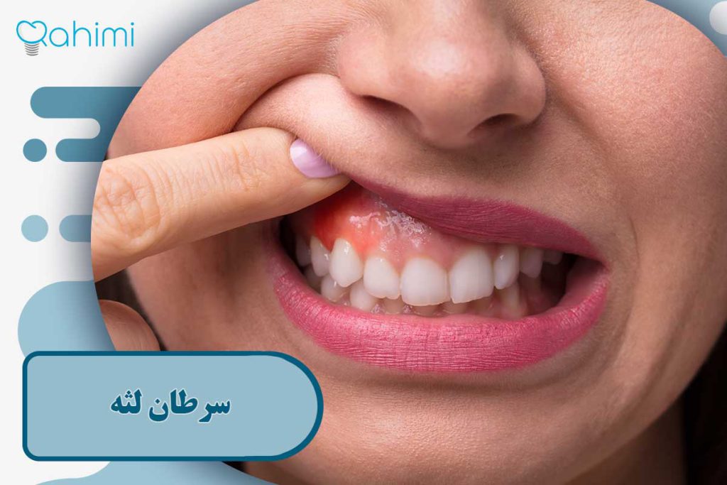 سرطان لثه