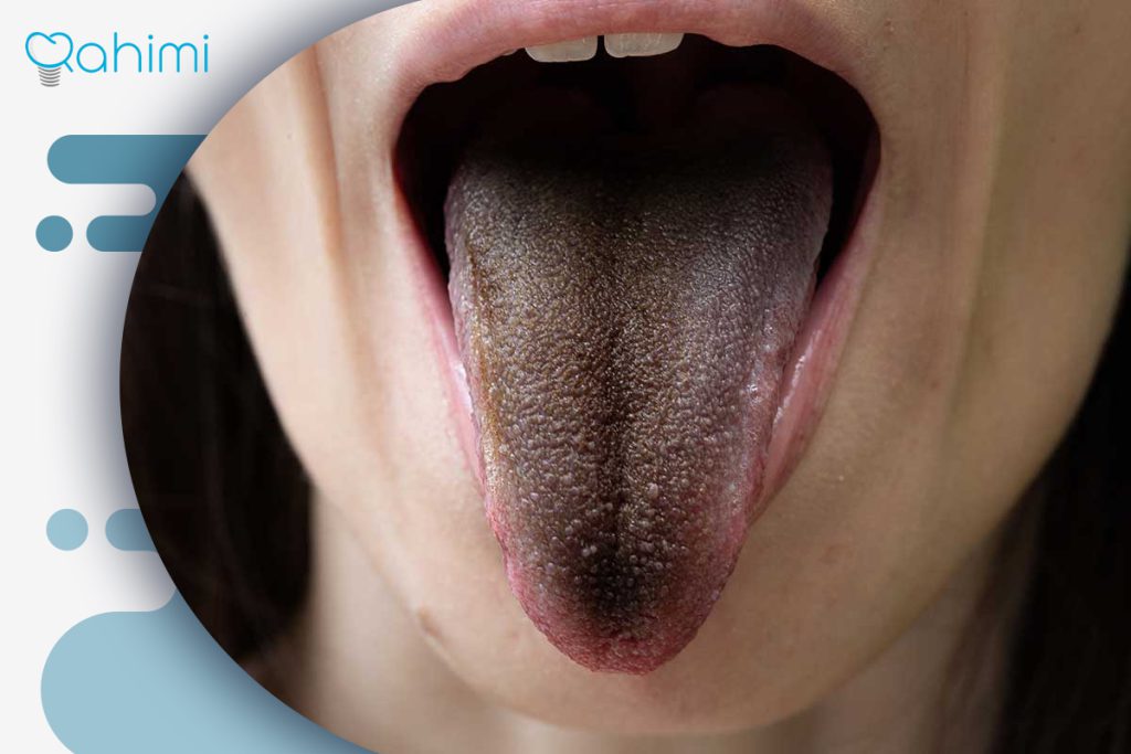 علت قهوه ای شدن زبان: دلایل پزشکی، رژیم غذایی و روشهای پیشگیری مؤثر 3 زبان مودار سیاه