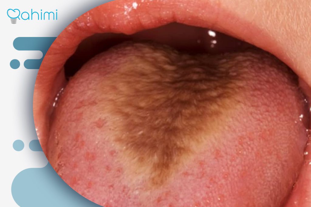 علت قهوه ای شدن زبان: دلایل پزشکی، رژیم غذایی و روشهای پیشگیری مؤثر 4 قهوهای شدن زبان