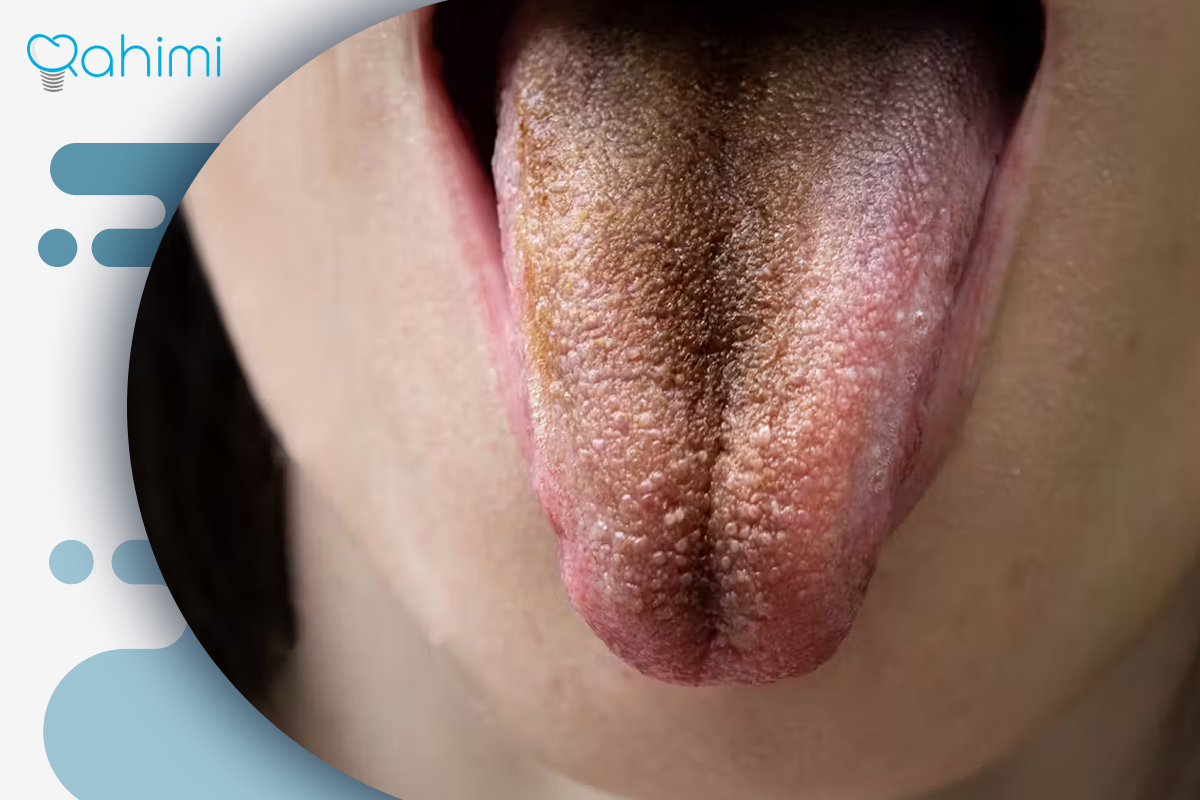 رنگ قهوه‌ای زبان