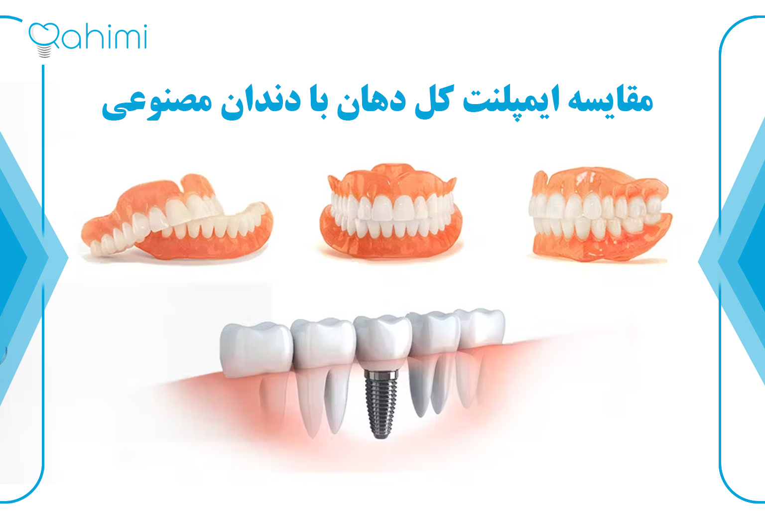 کاشت ایمپلنت کل دهان (فول موس) 5 Comparison of whole mouth implants with artificial teeth 1