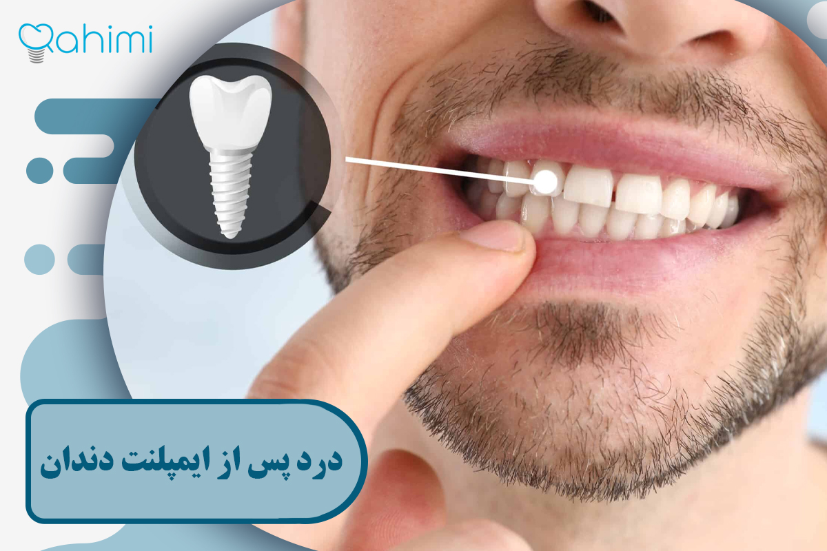 درد پس از ایمپلنت دندان