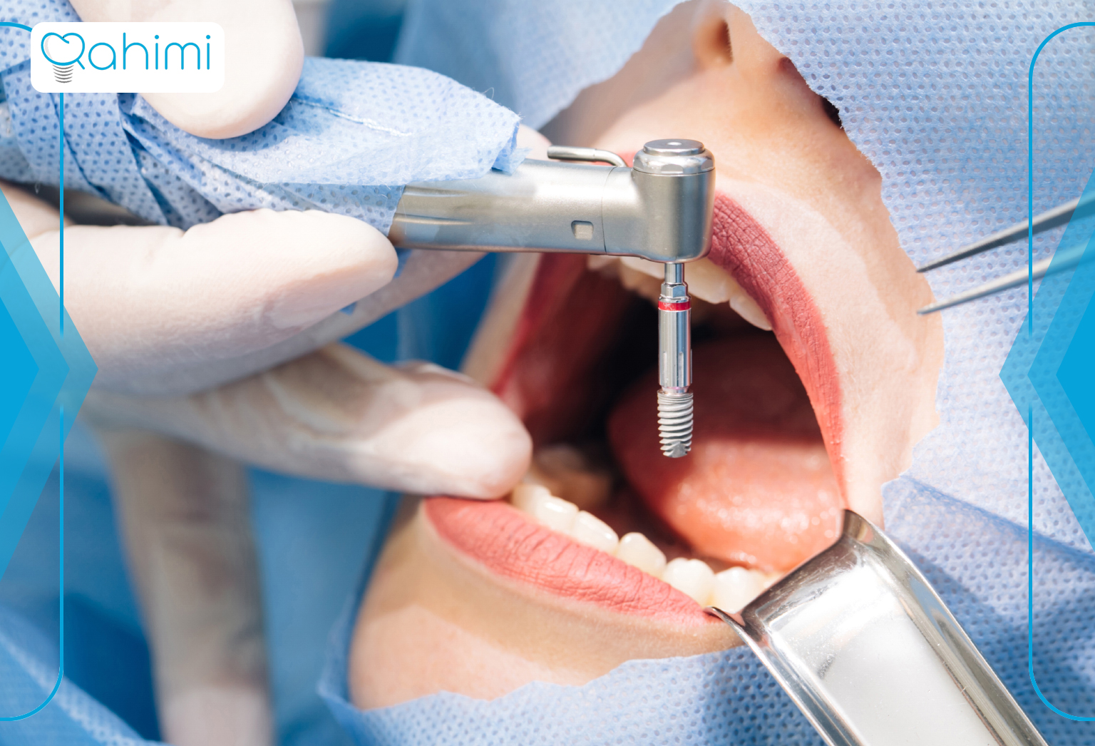 The advantage of patient anesthesia during dental implants