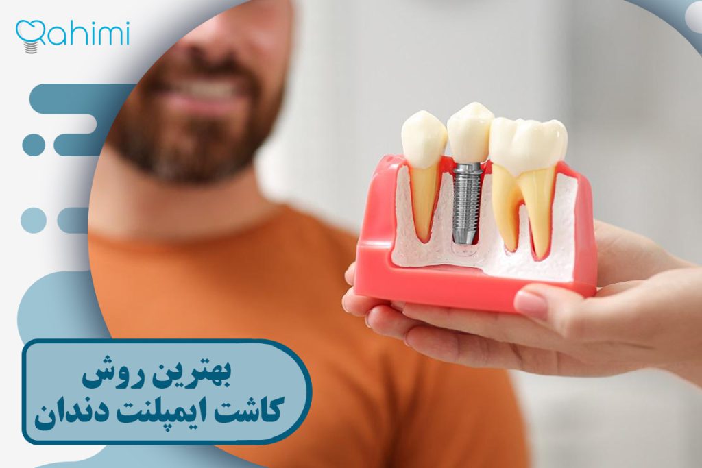 بهترین روش کاشت ایمپلنت دندان