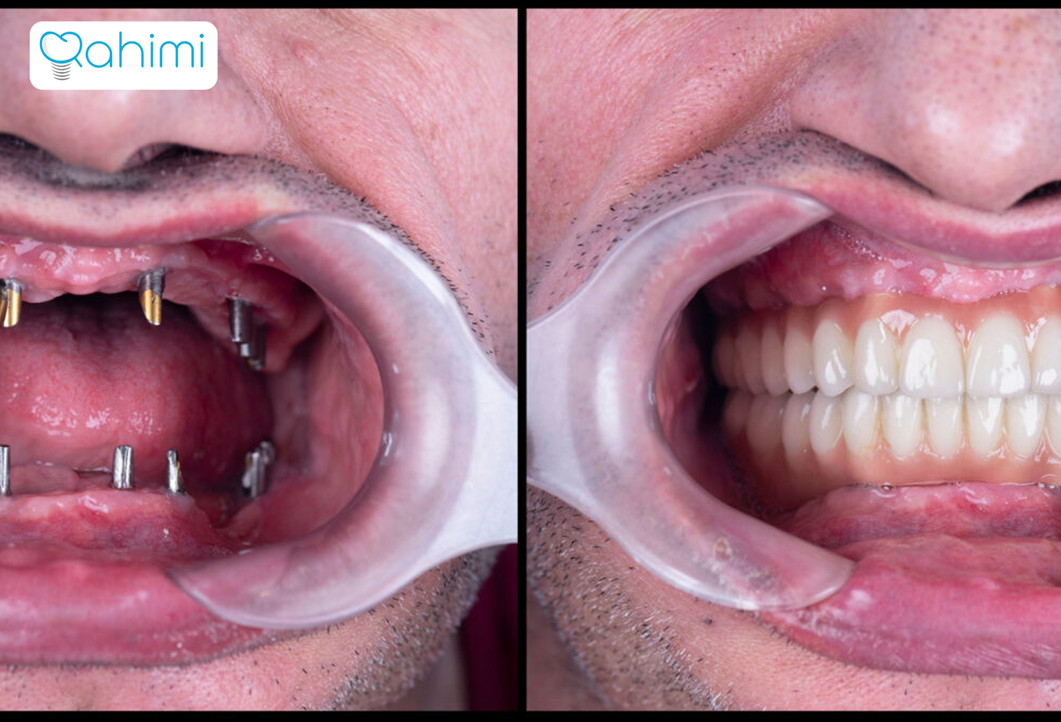 کاشت ایمپلنت کل دهان (فول موس) 6 The number of implants required for the upper and lower jaw